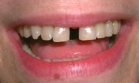 Before Image: Empress Porcelain Veneers Smile Makeover - front