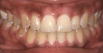 After Image: Orthodontic before and after photos treated by Dr. Tracy Pogal-Sussman - front