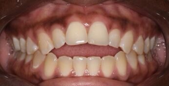 Before Image: Orthodontic before and after photos treated by Dr. Tracy Pogal-Sussman - front