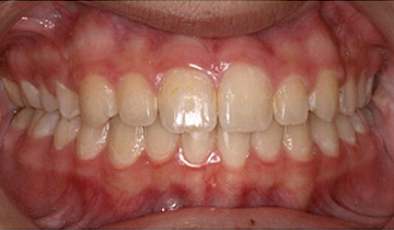 After Image: Orthodontic Before and After - front