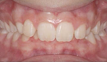 Before Image: Orthodontic Before and After - front