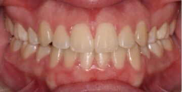 After Image: Orthodontics – Crowding - front