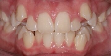 Before Image: Orthodontics – Crowding - front