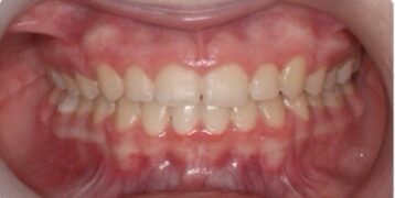 After Image: Orthodontics – Deep bite - front