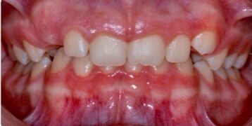 Before Image: Orthodontics – Deep bite - front