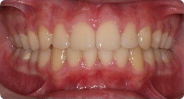 After Image: Orthodontics Patient of Dr. Tracy Pogal-Sussman - front