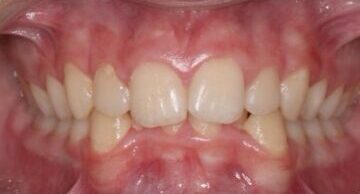 Before Image: Orthodontics Patient of Dr. Tracy Pogal-Sussman - front