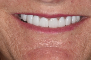 After Image: Porcelain Veneers and Crowns - front