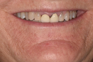 Before Image: Porcelain Veneers and Crowns - front