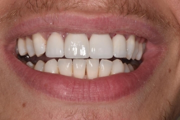 After Image: Porcelain veneers to close spaces - front