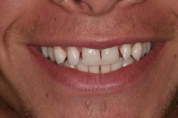 Before Image: Porcelain veneers to close spaces - front