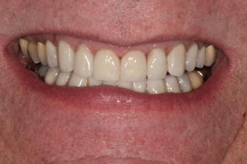 After Image: Smile Makeover - front