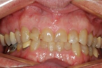 Before Image: Smile Makeover - front